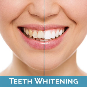Teeth Whitening in Hamilton Township