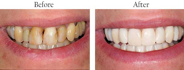 Hamilton Township Before and After Dental Implants