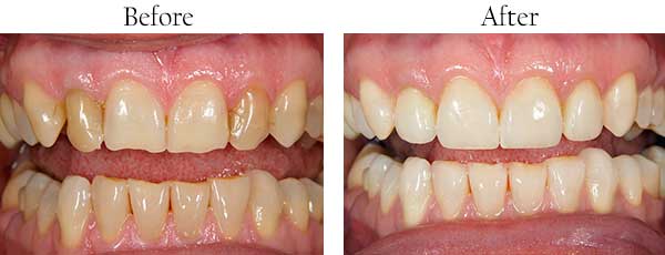 Lawrenceville Before and After Invisalign